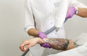 6 Questions to Ask Before Booking Laser Tattoo Removal in Singapore
